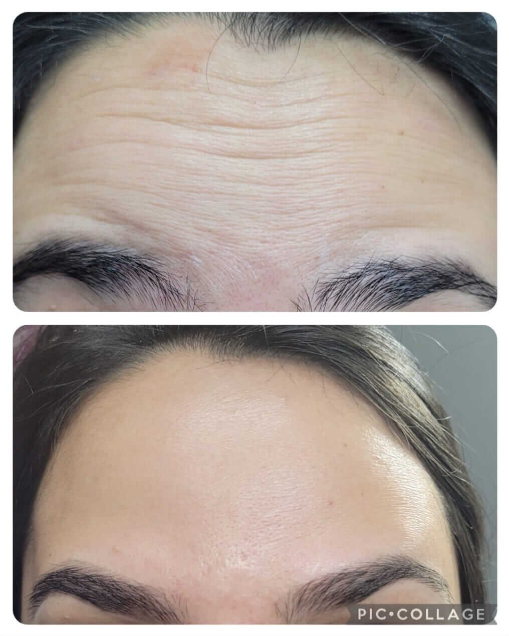 antes+e+depois+harmonizacao