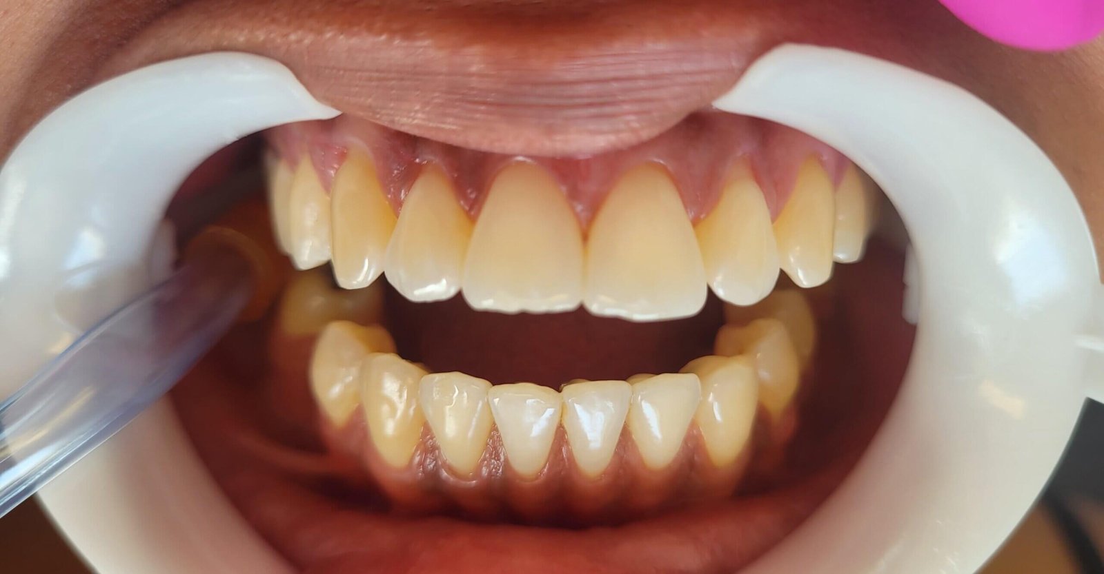 dentista+zona+norte+sp