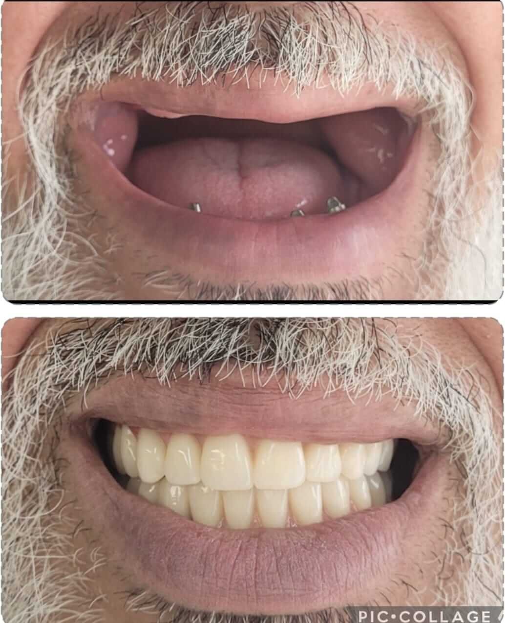 implantodontia+santana+zona+norte(1)