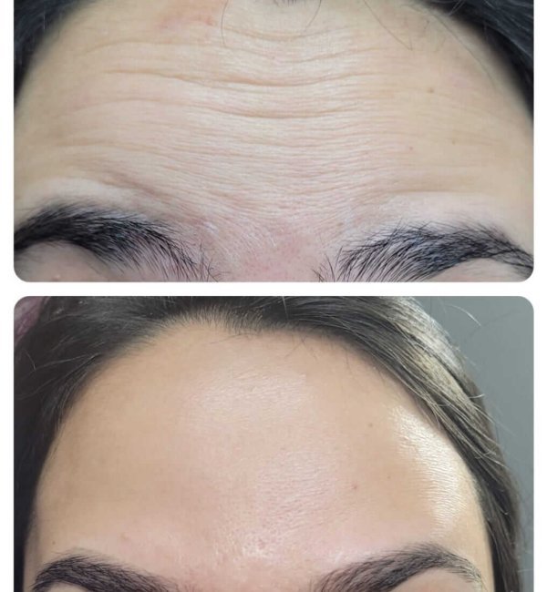 antes+e+depois+harmonizacao