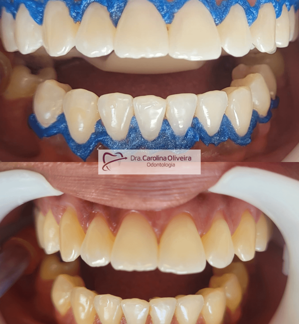 clareamento+dental (1)