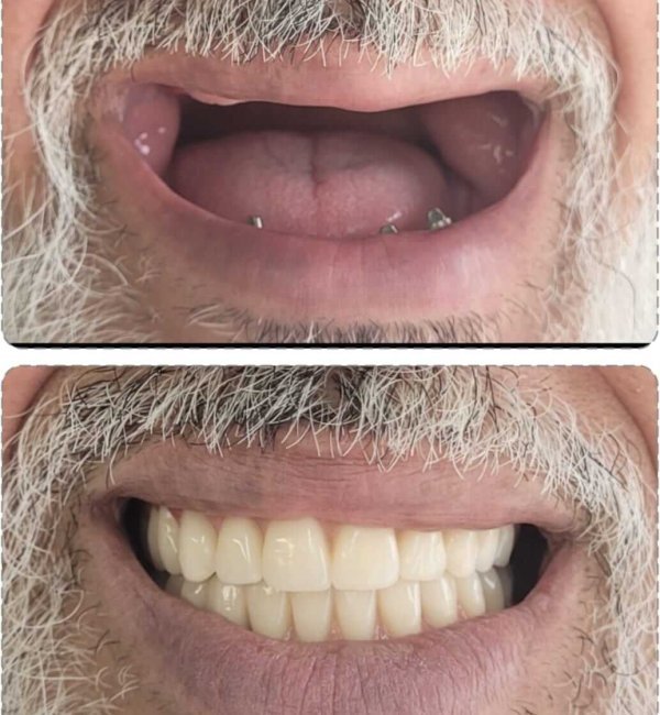 implantodontia+santana+zona+norte(1)